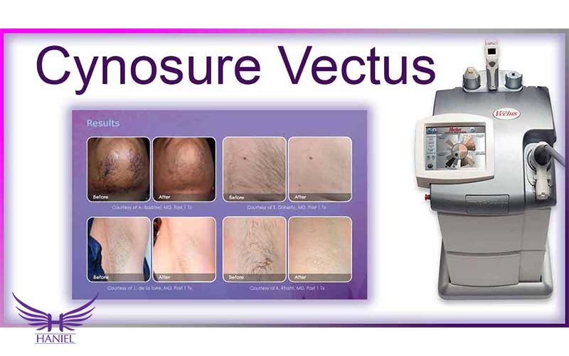 فناوری-Cynosure-Vectus