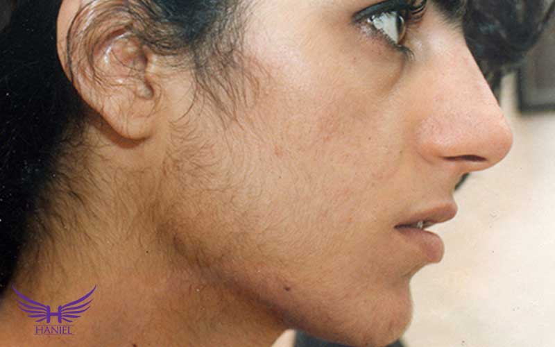 علائم-مردمویی-چیست؟