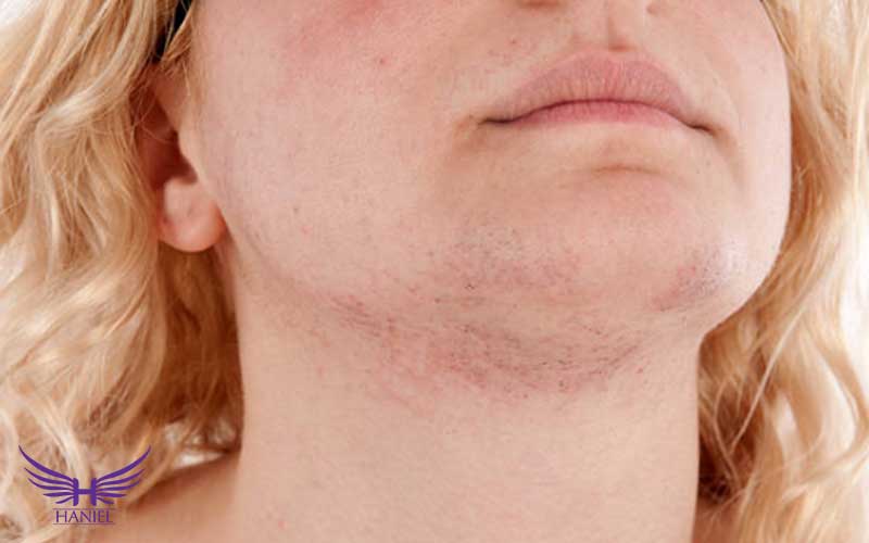 نحوه-تشخیص-هیرسوتیسم