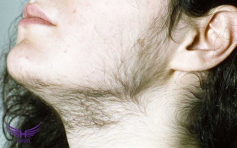 هیرسوتیسم-چیست؟