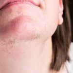 هیرسوتیسم یا پرمویی خانم ها